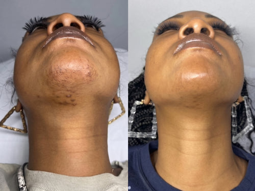 Cyperus Rotundus Regrowth Prevention