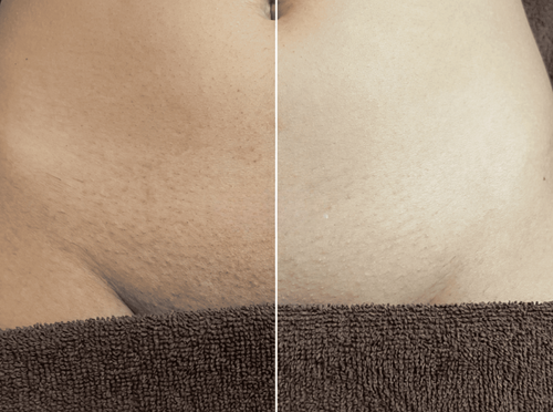 Cyperus Rotundus Regrowth Prevention